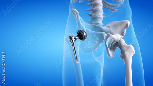 3d rendered medically accurate illustration of a hip replacement photo