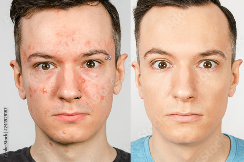 two guys before-after: left guy with acne, red spots, problem skin, right guy with healthy skin. Acne treatment concept