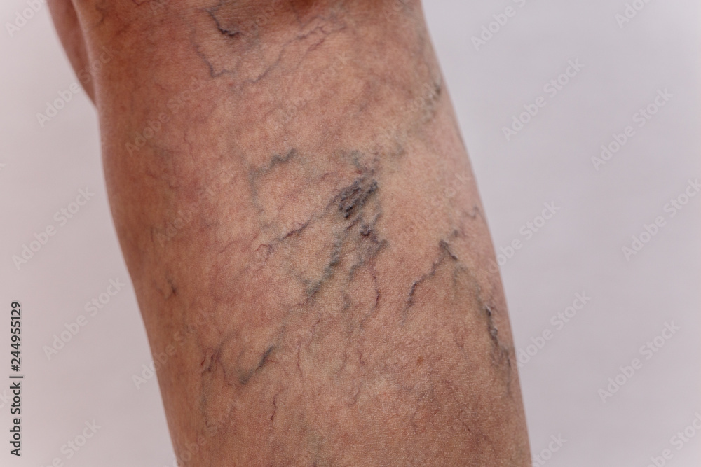 Legs of old woman with varicose veins. Stock Photo