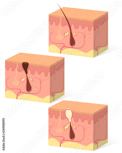 Isolated sample of human skin with a hair follicle, acne, inflammation, pimple, dermatology, skin structure