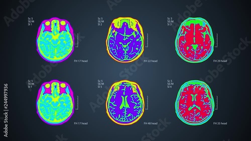 Brain MRT scan. 6 views on one screen.  Each video is loopable. 4k medical colorful background photo