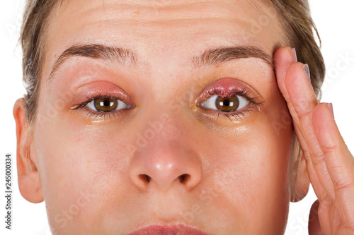 Foto Chalazion - Eyelid infection