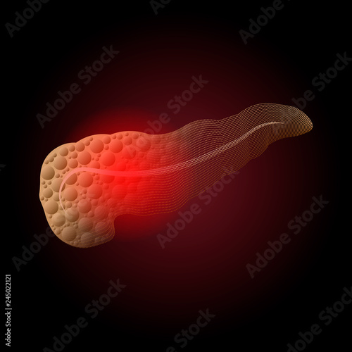 Pancreatitis. Medical illustration of diseases of the pancreas of a real organ to x-ray effect from dots with a point of inflammation.