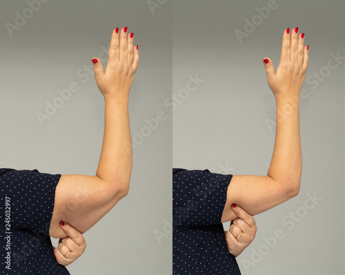 Fotografia Flabbiness on woman arm before and after slimming diet