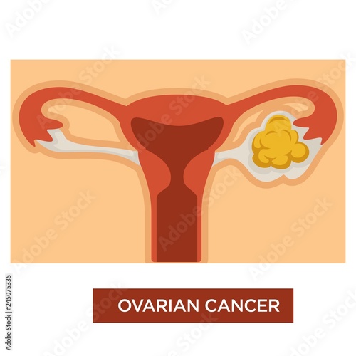 Ovarian cancer female reproductive system disease vector