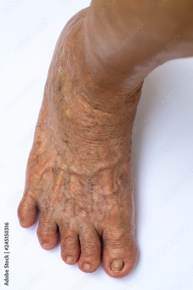 Fototapeta premium Skin Blood Varicose veins on right foot, Damaged toenail, Crooked toes in Senior women, White background, Close up & Macro shot, Selective focus, Body part, Healthcare concept