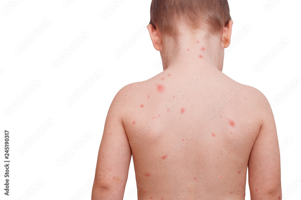 Closeup, full of blisters,scar and rash caused by chickenpox on a white ...