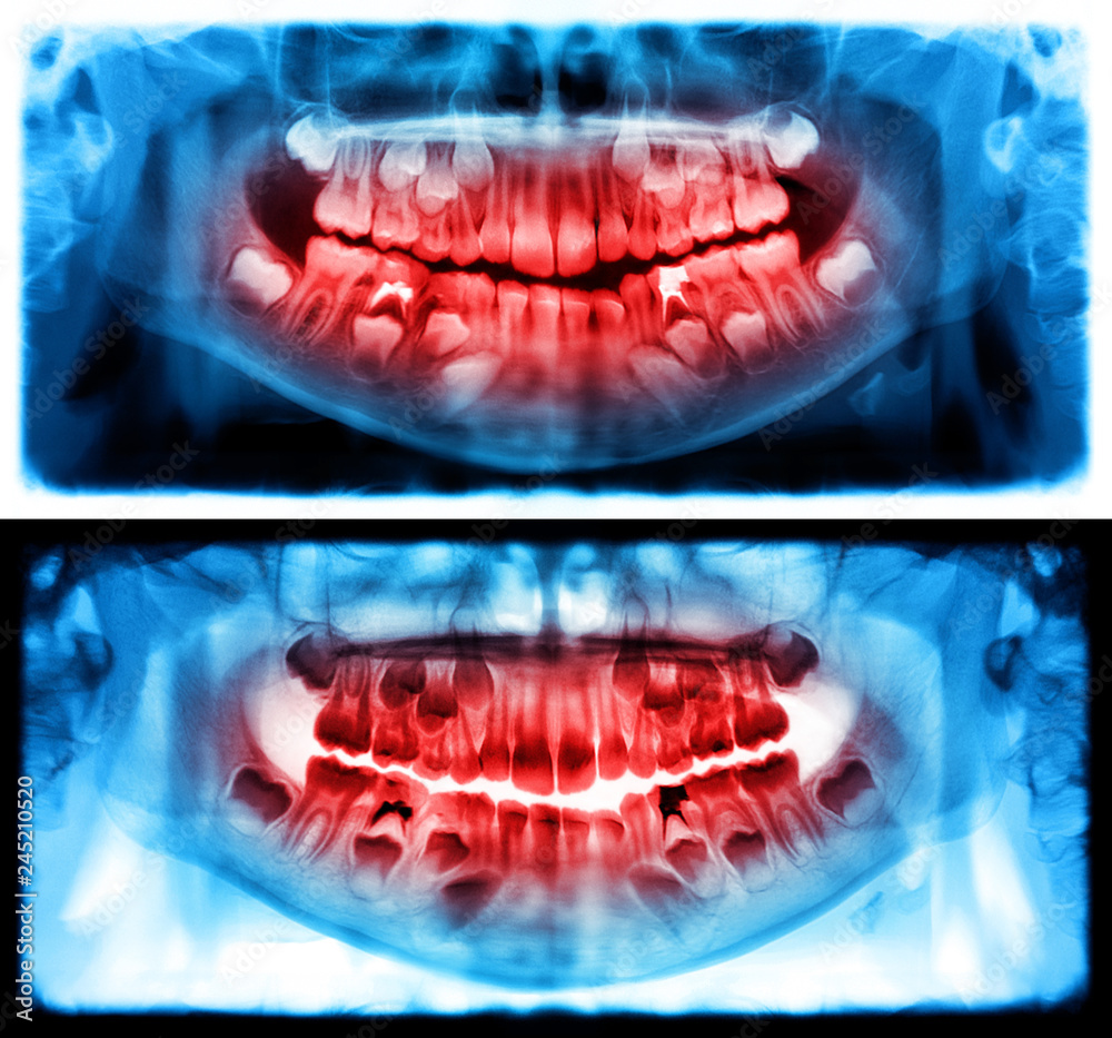 Panoramic radiograph is a scanning dental Xray of the upper jaw