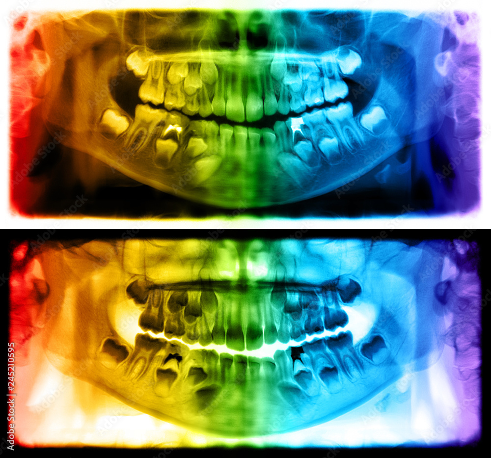 Panoramic Radiograph Is A Scanning Dental X-ray Of The Upper Jaw 