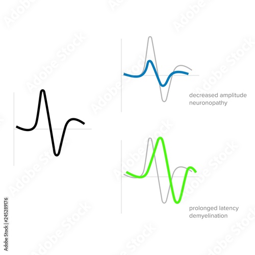 Graphic waves of electromyographic medical examination - Vector photo