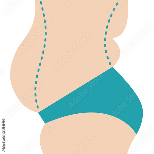 Liposuction of abdomen