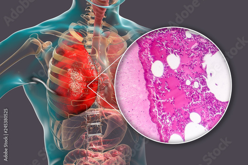 Fotografie Lobar pneumonia, hemorrhagic edema period, 3D illustration and light micrograph,