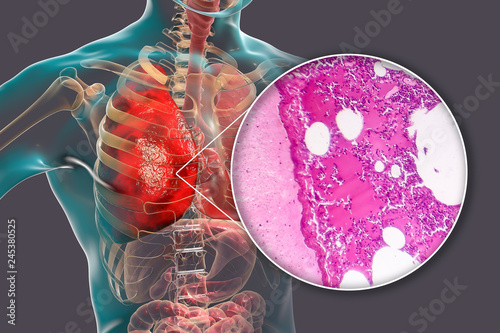 Lobar pneumonia, hemorrhagic edema period, 3D illustration and light micrograph, photo under microscope photo