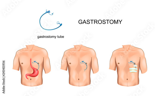 gastrostomy tube. surgery photo