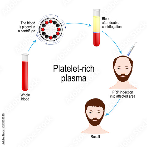 Platelet-rich plasma. PRP Hair Therapy. Medical procedure. photo