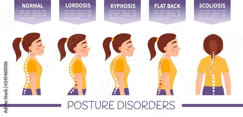 Infographics of posture disorders.  Types of posture. Illustration of cute girl. photo