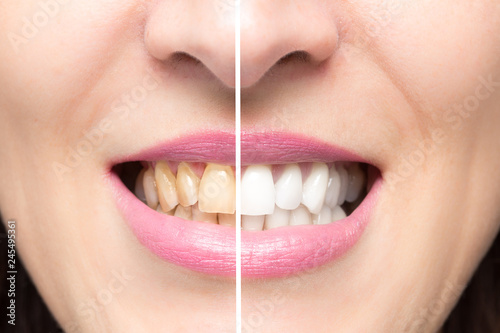 Close up of female yellow teeth before and after whitening treatment