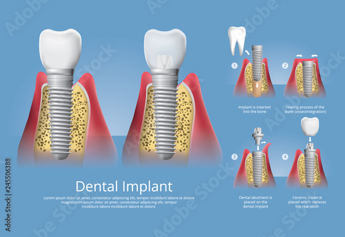 Human teeth and Dental implant Vector Illustration