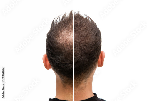 Vorher Nachher - Halbglatze eines Mannes mit Haarausfall
 photo