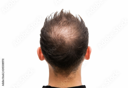 Halbglatze eines Mannes mit Haarausfall
 photo