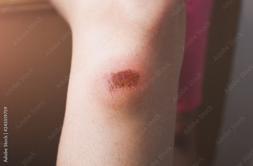 Abrasion on the woman's knee. Injured leg with a red wound. Medical treatment for first aid.