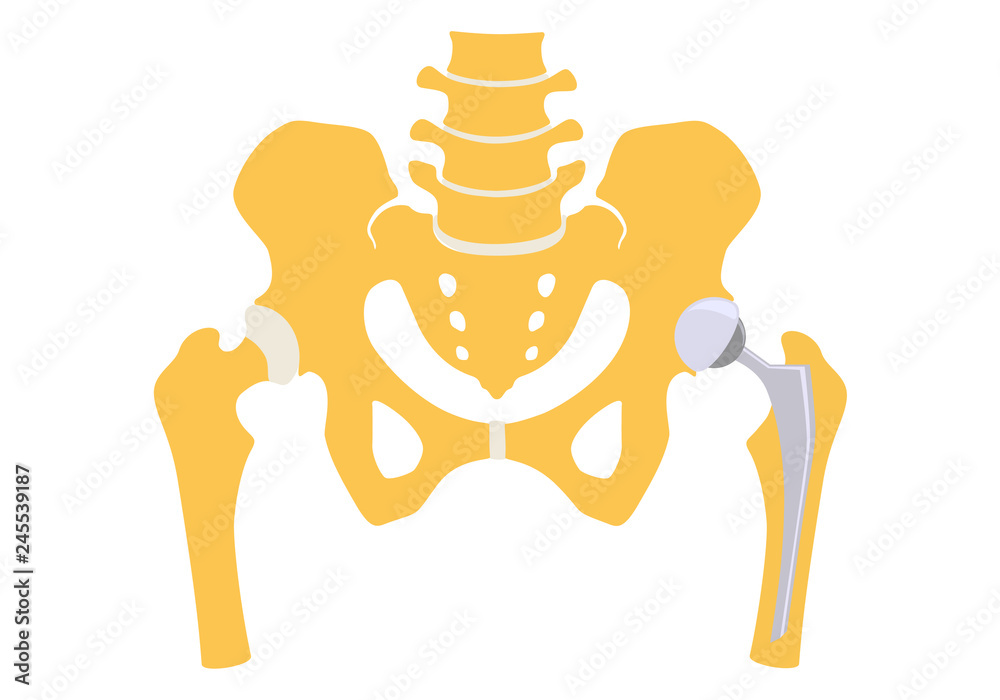 Total hip replacement. Vector illustration. - obrazy, fototapety, plakaty 