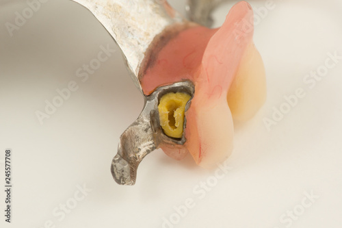 bugel remove dentures with attachments photo