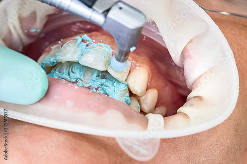 Zähne polieren beim Zahnarzt photo