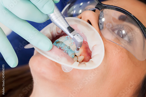 Zähne polieren beim Zahnarzt