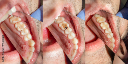 Εκτύπωση καμβά Dental caries