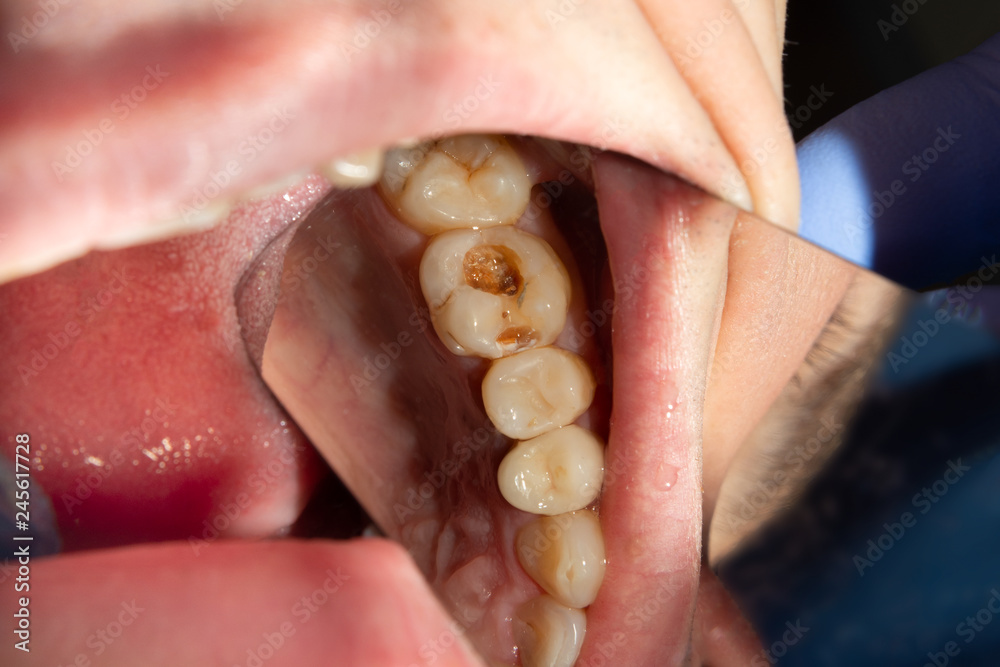 Obraz premium Dental caries. Filling with dental composite photopolymer material using rabbders. The concept of dental treatment in a dental clinic