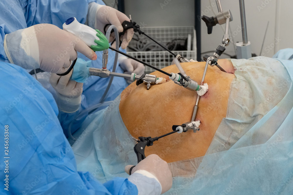 Foto de Endoscopy. Laparoscopy. The hands of doctors using laparoscopic