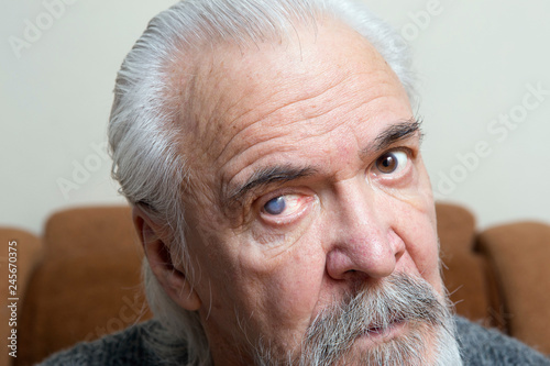 Eye disease in an old man photo