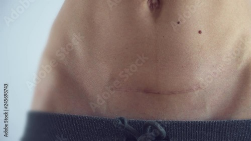 closeup of woman belly with scar c section on skinny girl delivery birth medicine concept 4k