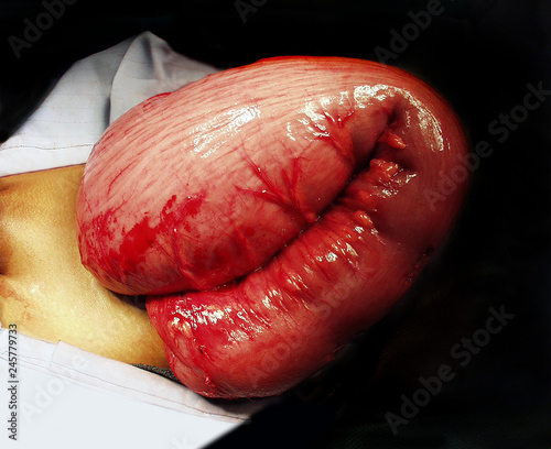 Hirschsprungs disease transition zone