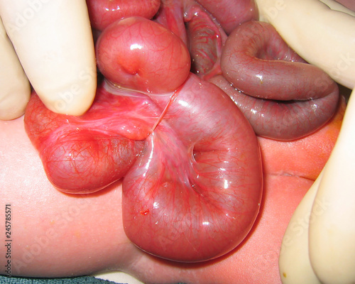 Band in gastroschisis bowel