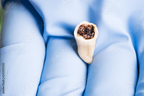 Extracted rotter molar isolated in dentist’s hand with blue medical glove 