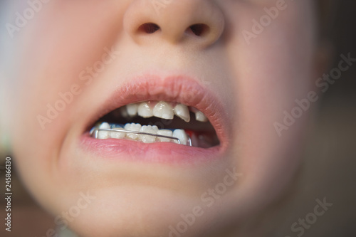 Photo of a little girl s mouth with an orthodontic appliance and crooked teeth.