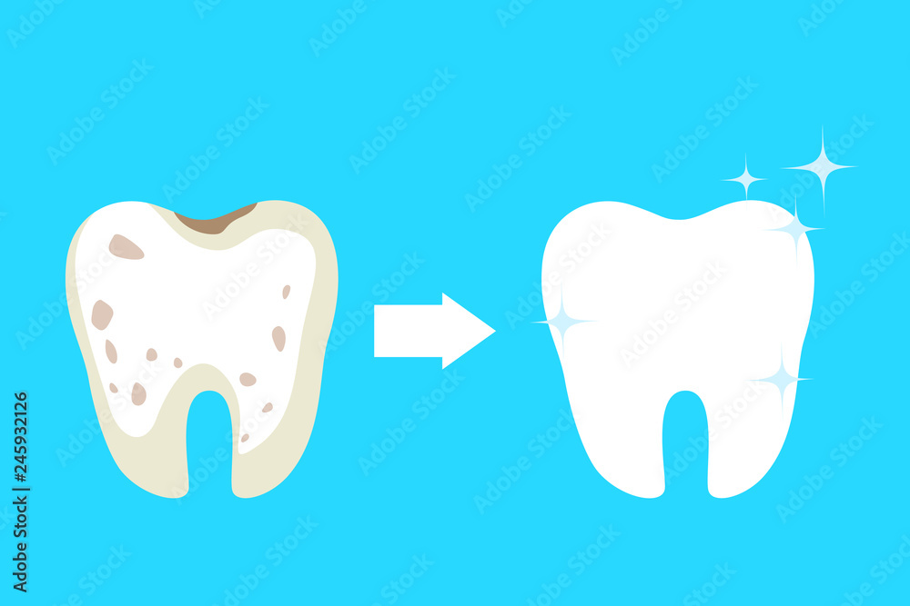 Teeth whitening concept. Tooth become white in dental clinic Teeth whitening concept. Tooth become white in dental clinic