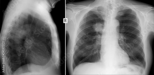 X-ray of the lungs. Central cancer of the right lung. 