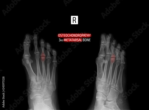 X-ray of the foot. Osteochondropathy of the 3th metatarsal bone. Marker. photo