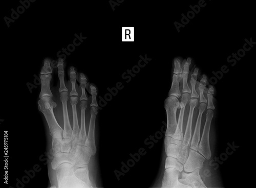 X-ray of the foot. Osteochondropathy of the 3th metatarsal bone.  photo