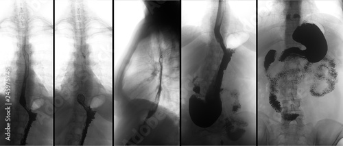 X-ray of the upper gastrointestinal tract (UGI) with barium. Hiatal hernia. Negative.  photo