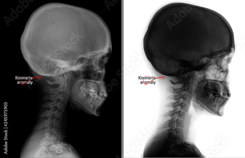 X-ray of the cervical spine. Kimerly anomaly. Cervical dysfunction. Marker. photo