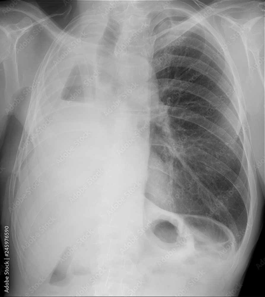 X-ray of the lungs. Right-sided pneumonectomy. X-ray of the lungs. Right-sided pneumonectomy.