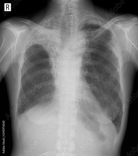 X-ray of the lungs: Postradiation pneumofibrosis. 