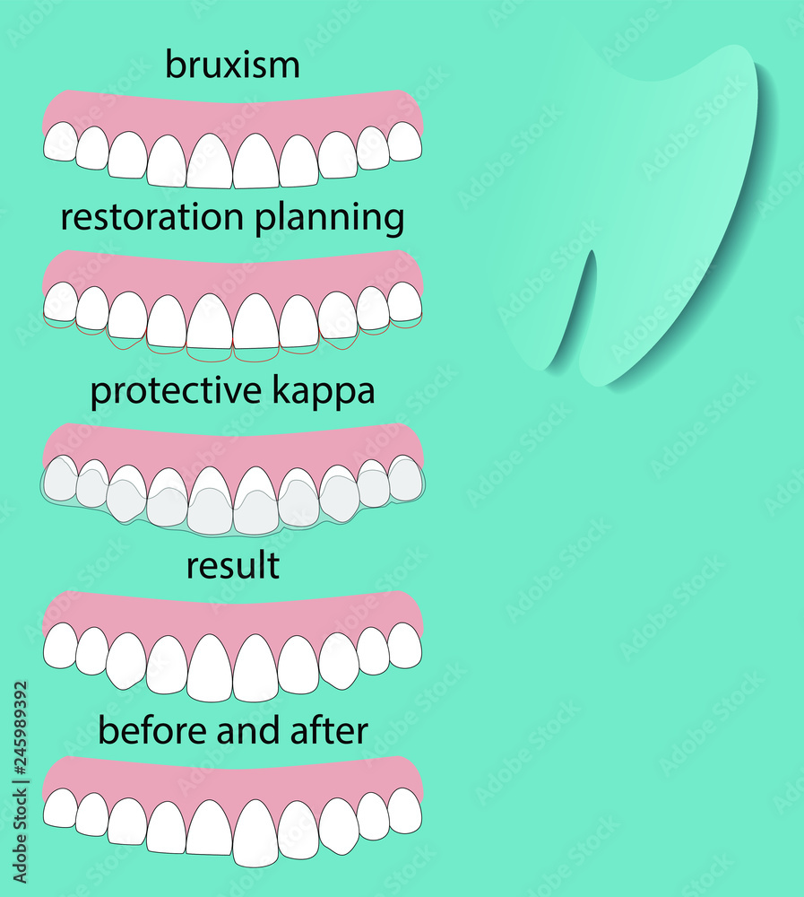 Layout attrition Bruxism illustration vector. Erased teeth. Restoration of teeth. Protective kappa. Dental concept. Stock-vektor | Adobe Stock