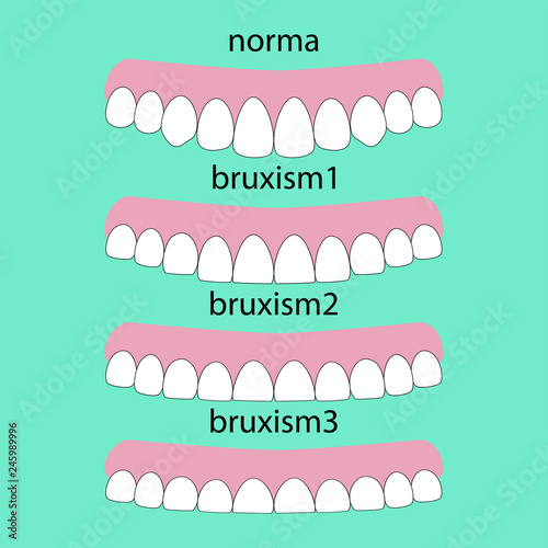 Types of teeth erasability. Layout attrition Bruxism teeth illustration vector. Erased teeth. Dental concept.