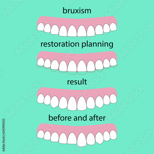 Layout attrition Bruxism teeth illustration vector. Erased teeth. Restoration of teeth. Dental concept.