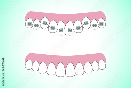 Vector illustration of the stages of orthodontic treatment braces on teeth . Teeth before and after braces on . Background in flat style.